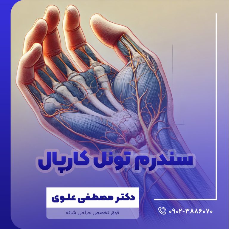 سندرم تونل كارپال