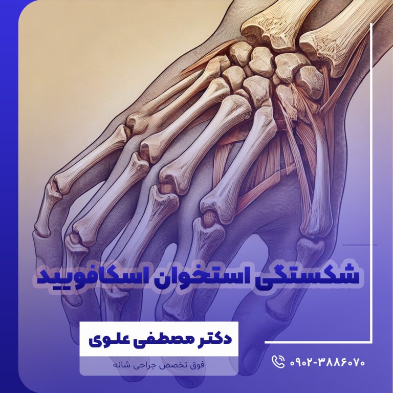 شکستگی استخوان اسکافویید
