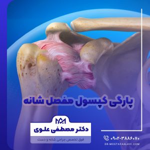 پارگی کپسول مفصل شانه